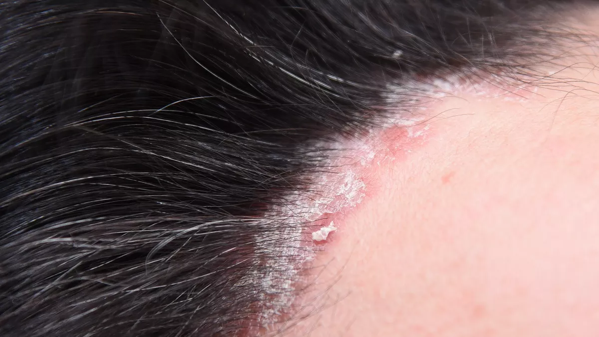 dermatite seborroica può causare la perdita dei capelli